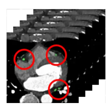 Coronary region of interest detection