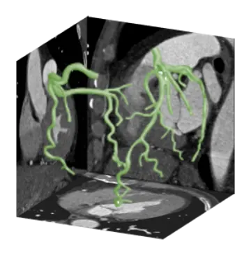 Three-dimensional coronary model